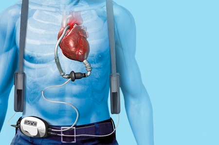 LVAD технологиялар